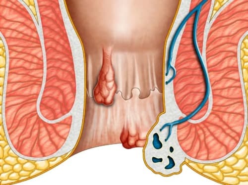 Hemorricin dapatkah digunakan