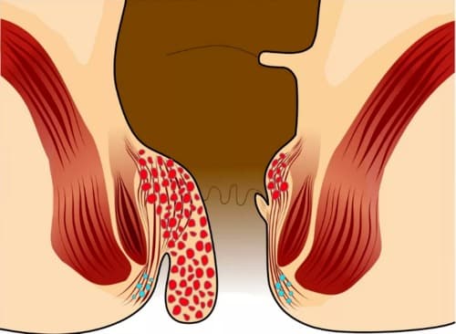 Hemorricin apakah nya bagus